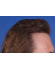 After Hair Transplant&nbsp;2 Sessions (Areas)